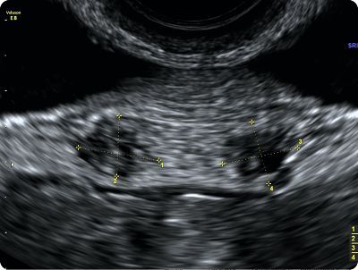 sonofetal-mapeo de endometriosis profunda